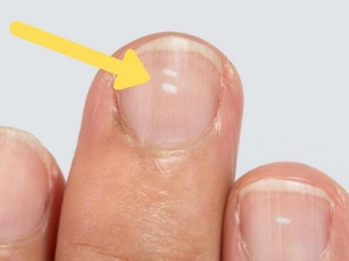 Znate li zašto ponekad imate male bijele mrlje na noktima?