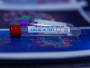 Predstavljen test koji razlikuje gripu od infekcije COVID-19