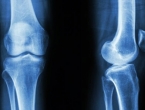 Stiže revolucija u liječenju prijeloma kostiju