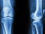 Stiže revolucija u liječenju prijeloma kostiju
