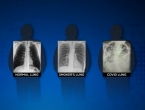 Liječnica uporedila pluća poslije koronavirusa i pluća pušača
