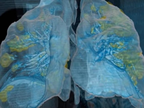 VIDEO: Pogledajte što koronavirus čini plućima