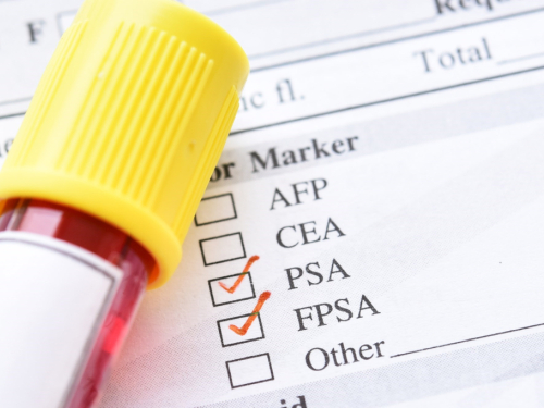 Jednostavan test otkriva rak prostate. 98% se izliječi ako ga otkriju na vrijeme