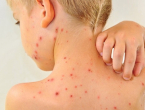 WHO i UNICEF pozivaju na brzu reakciju na epidemiju malih boginja u BiH