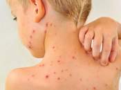 WHO i UNICEF pozivaju na brzu reakciju na epidemiju malih boginja u BiH