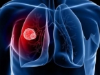 Lijek protiv raka pluća za šest do 12 mjeseci