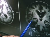 Povijesni trenutak u liječenju Alzheimera, novi lijek usporava razvoj bolesti