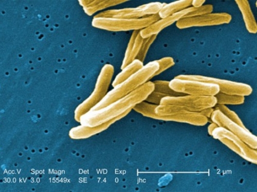 WHO: Tuberkuloza vodeći uzrok smrti