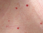 Imate ovakve crvene točkice po koži? Provjerite jesu li opasne