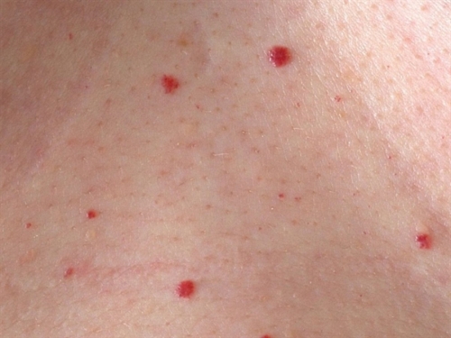 Imate ovakve crvene točkice po koži? Provjerite jesu li opasne
