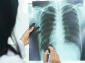 Tuberkuloza među deset vodećih zaraznih bolesti