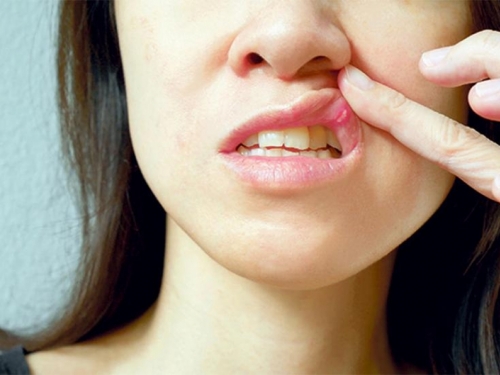 Kućni lijekovi za zacjeljivanje ranica u ustima