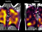 Dugi covid: Na posebnim snimkama pronađena skrivena oštećenja na plućima