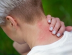 Ubod komarca: 7 pomagača koji odmah uklanjaju svrbež i crvenilo