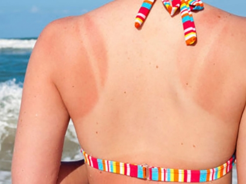 Mjere koje morate poduzeti kako biste zaštili kožu od štetnih UV zraka