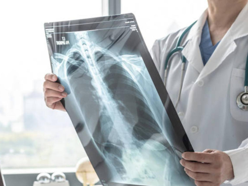 Stopa smrtnosti od raka pluća pada, evo što se pokazalo kao ključno