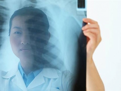 Njemački znanstvenici razvijaju test daha za rano otkrivanje raka pluća
