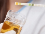 Najnoviji testovi urina mogli bi pomoći u tretiranju raka prostate