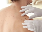 Najsmrtonosniji oblik raka kože nije melanom