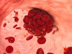 Krvni ugrušci kod covid pacijenata sadrže dijelove koronavirusa