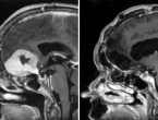 Kirurg uklanja veliki tumor mozga kroz obrve