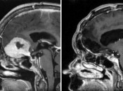Kirurg uklanja veliki tumor mozga kroz obrve