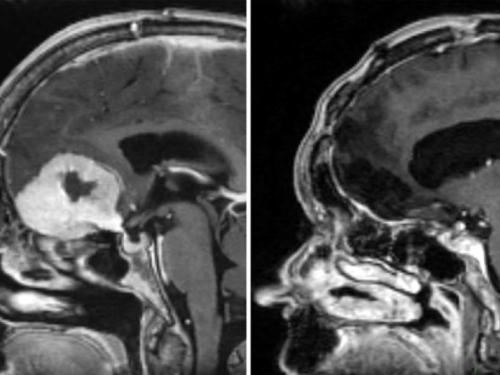 Kirurg uklanja veliki tumor mozga kroz obrve