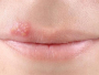 Herpes je znak naglog pada imuniteta