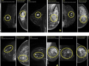 Umjetna inteligencija bi mogla omogućiti ranije otkrivanje raka dojke
