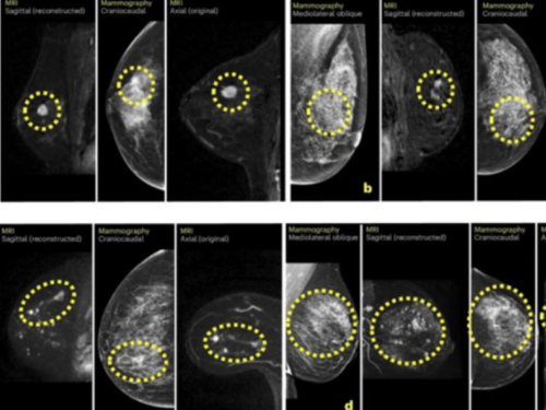 Umjetna inteligencija bi mogla omogućiti ranije otkrivanje raka dojke