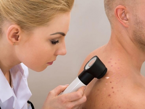 Raste broj muškaraca umrlih od raka kože