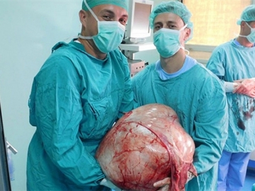 Banjalučki doktori odstranili tumor težak 31 kilogram
