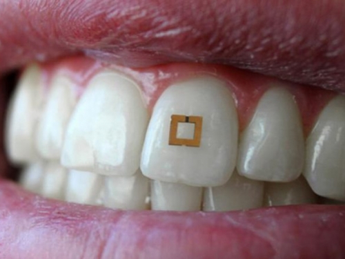 Znanstvenici osmislili senzor na zubu koji bilježi unos hrane