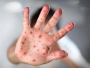 Zbog novca se ne želi proglasiti epidemija morbila u Federaciji?!