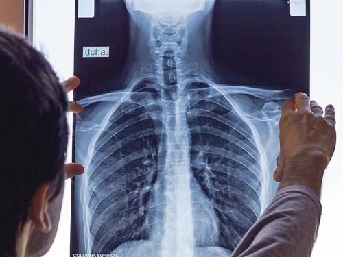 Hrvatski program ranog otkrivanja raka pluća proglašen najboljim u svijetu