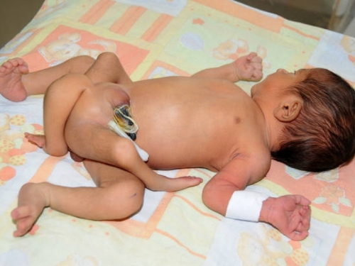 Doktori uklonili višak udova bebi rođenoj sa šest nogu