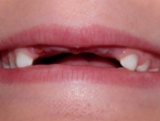 Ruski zubar ženi povadio 22 zdrava zuba