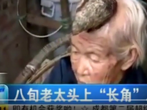 Liječnici u šoku: Ova starica ne želi operirati svoj rog