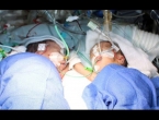 Liječnici razdvojili dosad najmlađe sijamske blizance